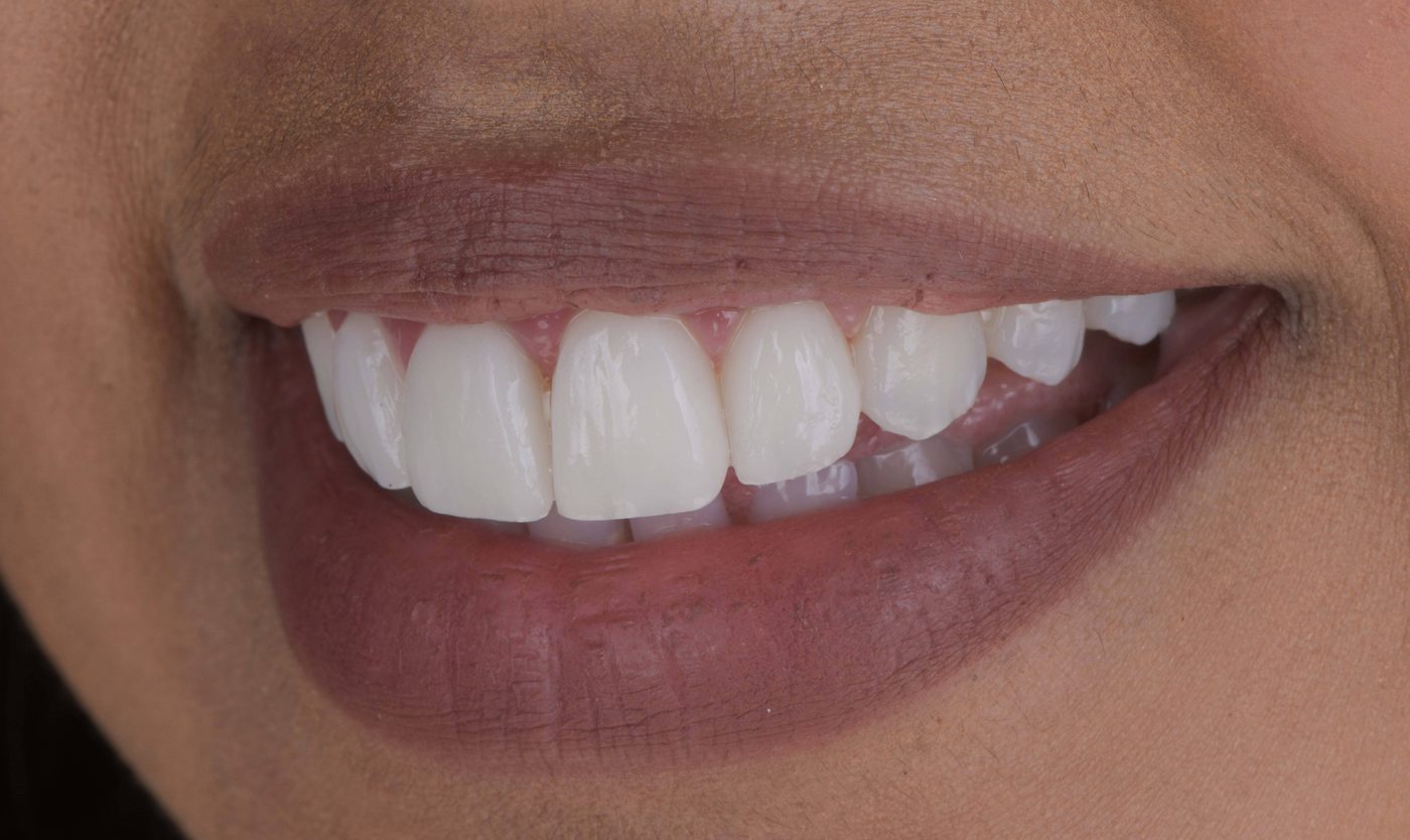 After ceramic veneers, Marylebone Smile Clinic patient