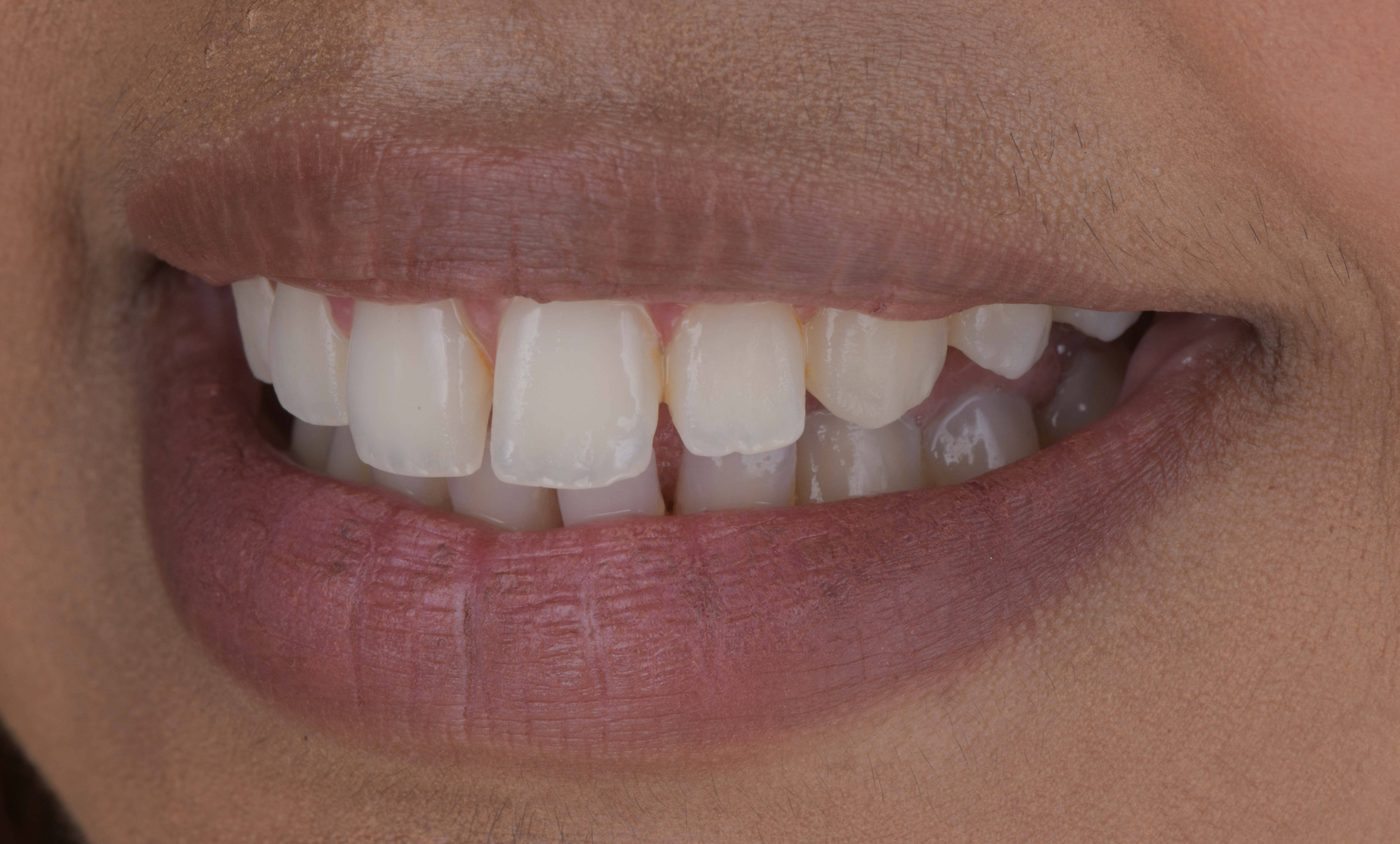 Before ceramic veneers, Marylebone Smile Clinic patient